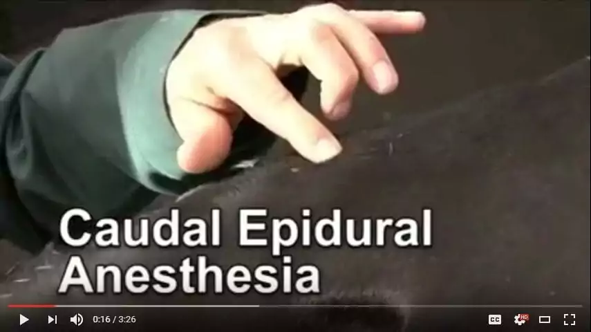 Caudal Epidural Anesthesia video