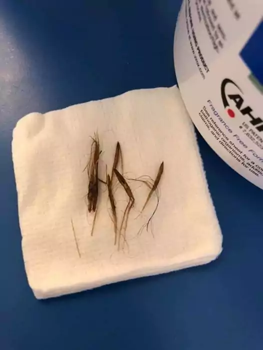 Foxtails that came out of a toy poodle’s ear by I Love Veterinary