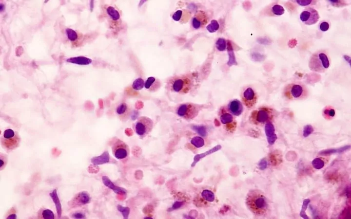 Histiocytes cells, Canine Histiocytoma Complex - I Love Veterinary