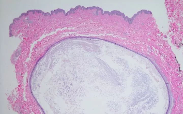 Sebaceous Cysts under microscope - I Love Veterinary