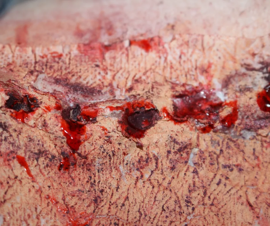 animal bite wounds on human skin