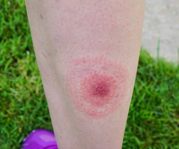 bite from an infected tick on human leg