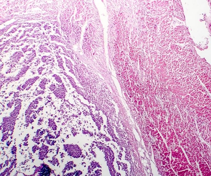 inflammatory bowel disease under the microscope