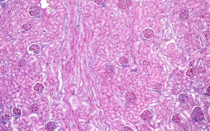 renal toxicity under the microscope